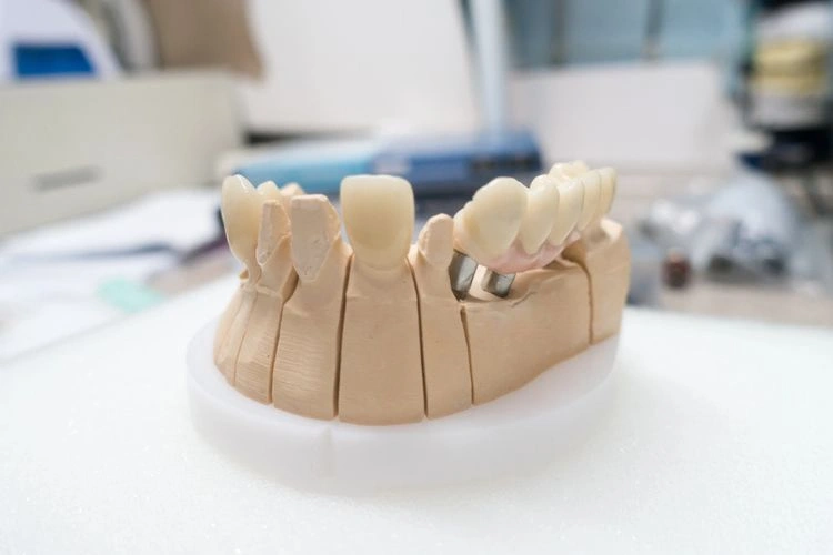 Fabrication d'une couronne dentaire